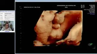 FETAL GENITALIA (SEX) Dr. Wiku Andonotopo