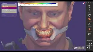 Integrating Metismile Facial Scans with Exocad and Blue Sky Plan