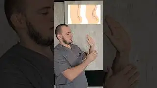 Как убрать боль при гиперлордозе поясницы #shortsvideo #больвспине #убратьболь