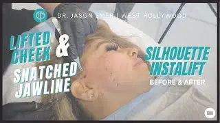 Before & After Silhouette Instalift Thread Facelift Procedure: Lifted Cheek & Snatched Jawline