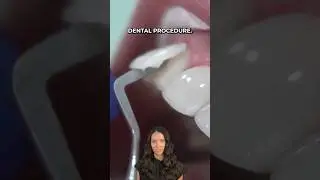 dental veneers at the dentist #shorts