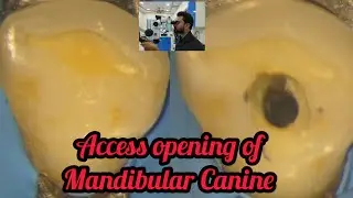 Access opening of Mandibular Canine step by step demonstration #rct for beginners #dental lectures