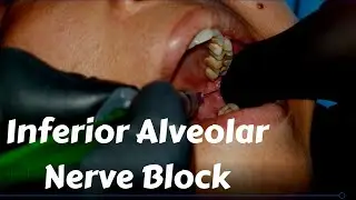 Inferior Alveolar nerve Block Injection in #dentistry  Landmark & Technique in Dental Teeth Surgery