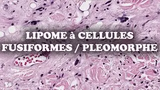 LE LIPOME A CELLULES FUSIFORMES / PLEOMORPHE – PATHOLOGIE