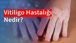 Vitiligo Hastalığı Nedir? | Medical Park