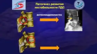Лекция 6 Этиопатофизиобиомеханикогенез дегенеративной нестабильности