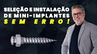 Como Selecionar e Instalar Mini Implantes Ortodônticos Corretamente 😲