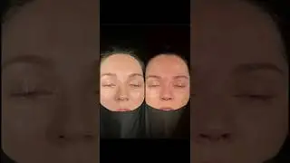 Revision Rhinoplasty Before and After Pictures