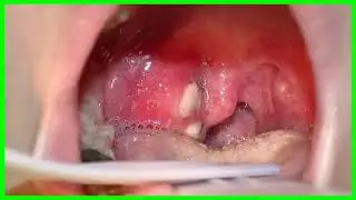 Amigdalitis Bacteriana Tratamiento Antibiotico