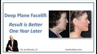 Deep Plane Facelift Looks Even Better After a Year