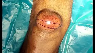 Knee cyst| abscess drainage and cyst excision| Dr. Pandiaraja