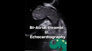 Bi-atrial thrombi
