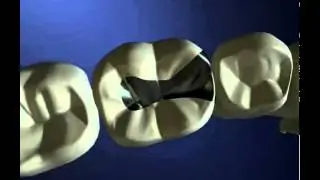 Worn Out Posterior Fillings - Miskin Ajax Dental