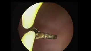 Transverse vaginal septum, Shawki innovative technique