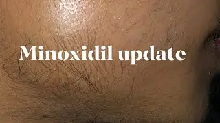 Minoxidil Journey Update