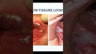 Anal fissure   Early versus Late fissure 