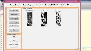 Spinal cord segmentation using morphology MATLAB project source code