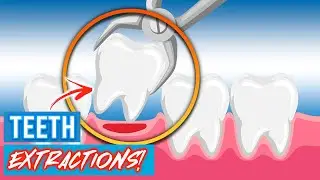 Tooth Extractions For Braces! | Why Do Orthodontists Extract Teeth?