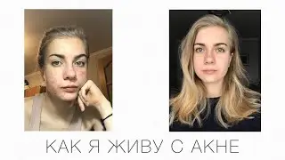 Как я живу с акне | hannaintheflesh