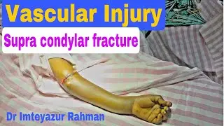 Arterial injury, vascular surgery, supra condylar fracture, Microsurgery