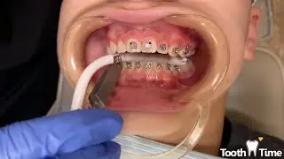 How braces are put on - 12 year old patient - Tooth Time Family Dentistry New Braunfels