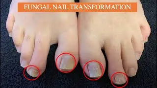 Revitalize Your Nails With Dr. Lloyd's Laser Treatment
