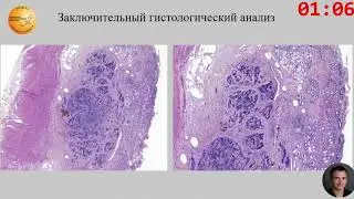 Инновационный метод эндоскопич. удаления нейроэндокринной опухоли луковицы двенадцатиперстной кишки