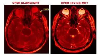 Kranioorbital tumor surgery result. Bemor Q.K. 1979.   #kranium #tumors