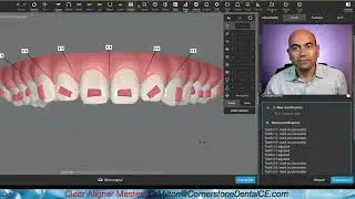 Clear Aligner Tip: Smile Design using the GRID.