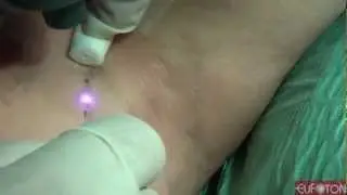 Phlebology | Reticular & Telangectasias - LASEmaR®800 [Eufoton®]