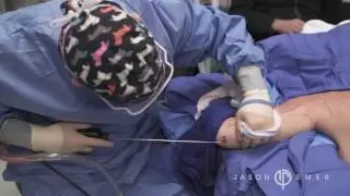 Liposculpture for Arms | Lipo to Reduce Arm Fat | Dr. Jason Emer