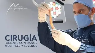 Cirugía retiro de Biopolímeros | Paciente con daños múltiples y severos. Parte 3