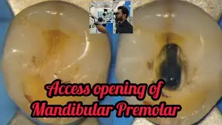 Access opening of Mandibular Premolar step by step demonstration# rct for beginners #dental lectures