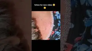 Самое залипательное видео давить прыщи Черные точки