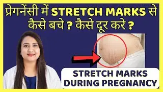 प्रेगनेंसी में STRETCH MARKS से कैसे बचे ? कैसे दूर करे ? STRETCH MARKS DURING PREGNANCY