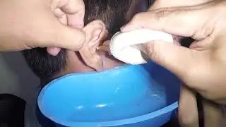 Man's Earwax Removed & Shattered to Pieces