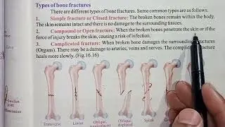 Types Of Fractures (Simple, Compound And Complicated Fractures)