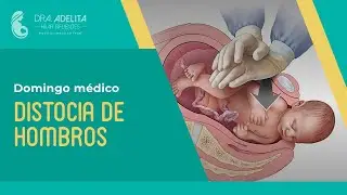 Distocia de hombros