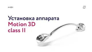 Установка аппарата Motion3D class II
