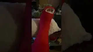 Fuß 2 mal gebrochen