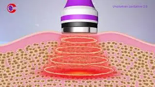 How Ultrasonic Cavitation Work? How Ultrasonic Cavitation Remove Fat? What Is  Cavitation Machine?
