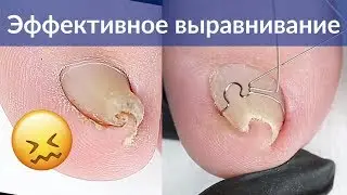 Как выровнять скрученный ноготь на ногах | Скоба на вросший ноготь | Педикюр