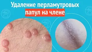 ✅ Удаление перламутровых папул на члене. Клинический случай №1457