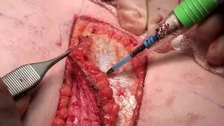 Anterior Intercostal Artery Perforator AICAP Flap in Partial Breast Reconstruction