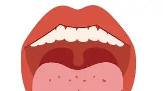 Vamos falar sobre cistos odontogênicos?
