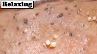 Deep Amazing Removal Of Blackheaads