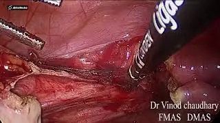 Total Laparoscopic Hysterectomy