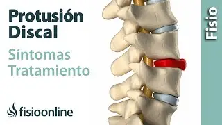 Protrusión de disco o discal - Qué es, causas, síntomas y tratamiento