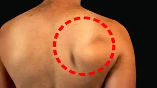 Why Your Shoulder Blade Wings (That EVERYONE Misses)