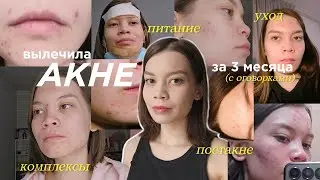 Я лечила акне 3 месяца, и вот как это было  | Всё об уходе за кожей, диете, комплексах